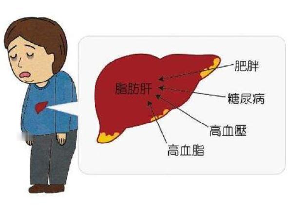 脂肪肝告知无药可治？中医健脾化浊，清肝化痰搞定它！

脂肪肝真无药可治吗？我的一