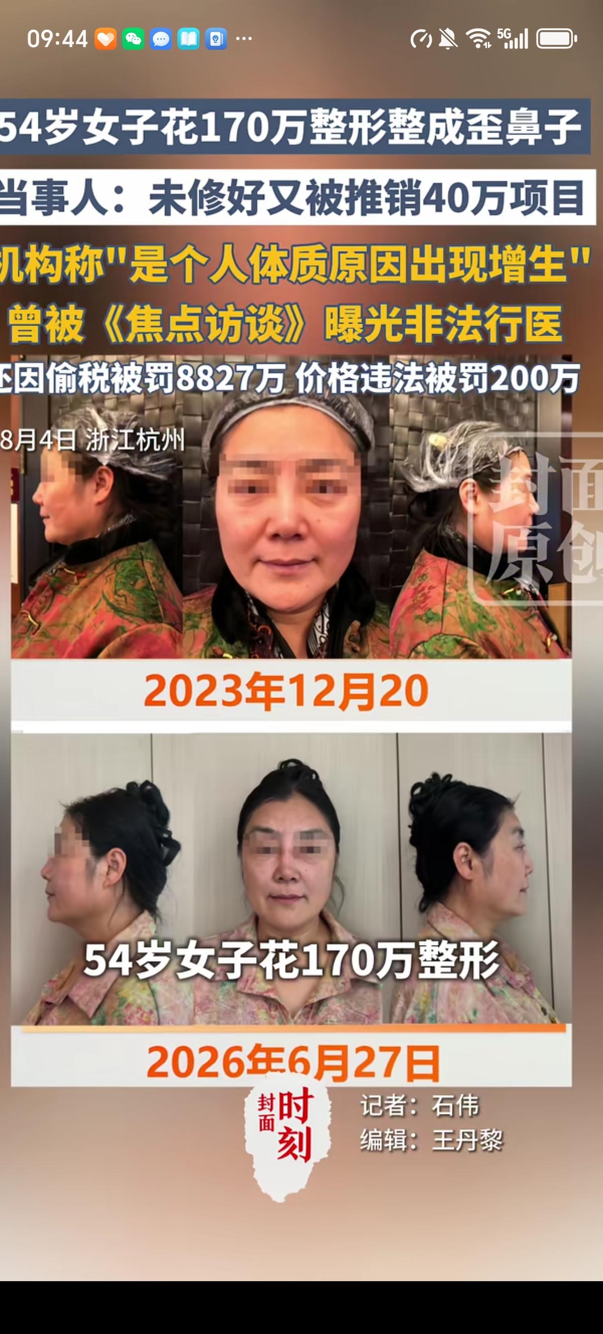 张女士看了“虞美人”广告后从国外飞回杭州花170万整形，加上路费200万元，整成