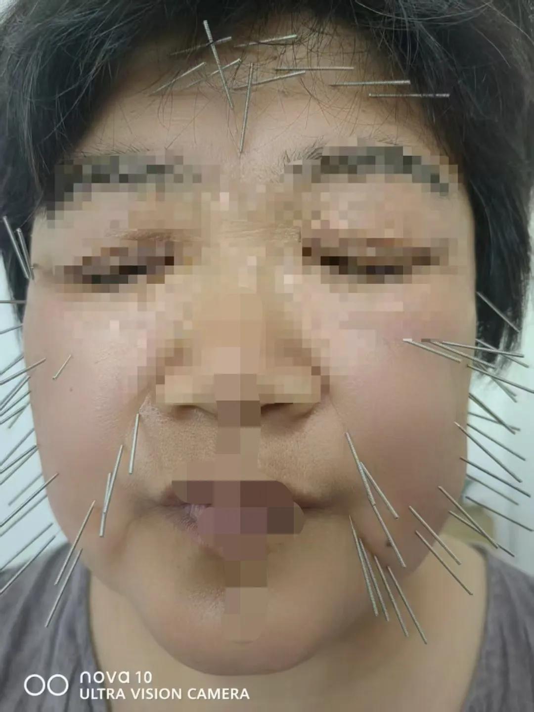 这种扎针法有意义吗？有的机构大力宣传用于面部提升效果有多神，只有鬼才相信，可是现