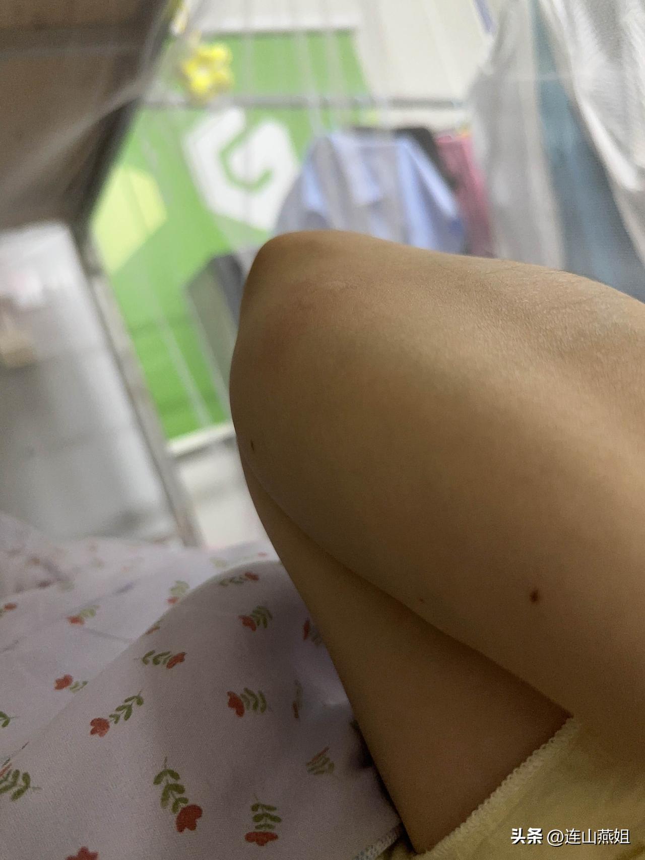 被蚊子咬醒，好痒[流泪]

蚊帐里面我找到两只，喝了我的血，肚子鼓鼓的臭蚊子🦟