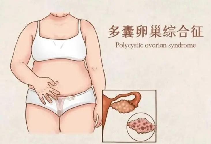 #健康真探社#【多囊卵巢综合征，怎么治疗才能更快好孕？】在快节奏的现代生活中，女