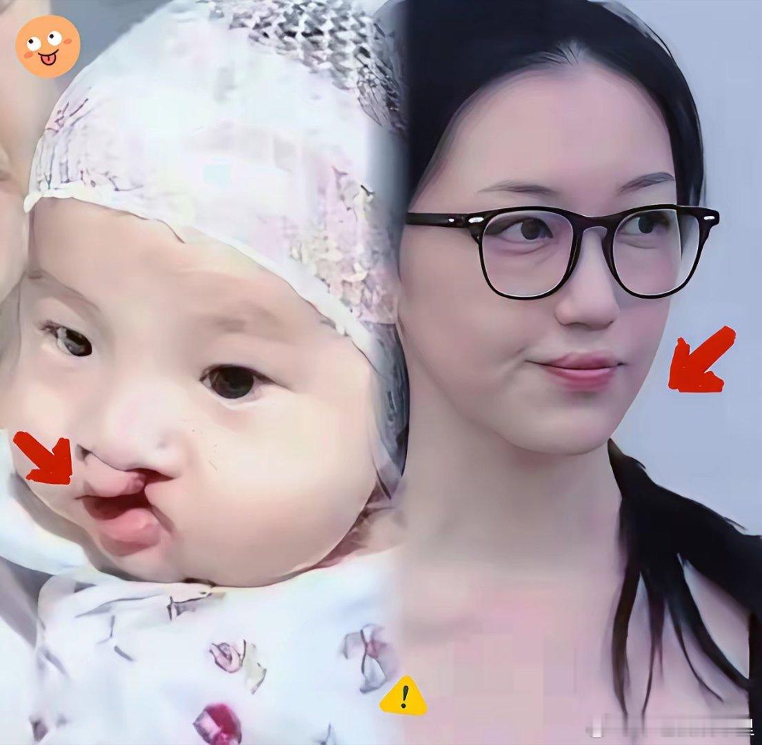 李嫣是幸运的兔唇出生庆幸生在李亚鹏家庭妈妈又是歌坛天后王菲，有能力给她做手术。这
