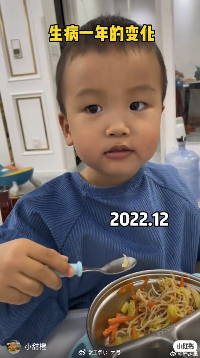 这个很吓人了，感染新冠后昏迷了几个月，醒过来智力归零了 [摊手]不得#新冠后遗症