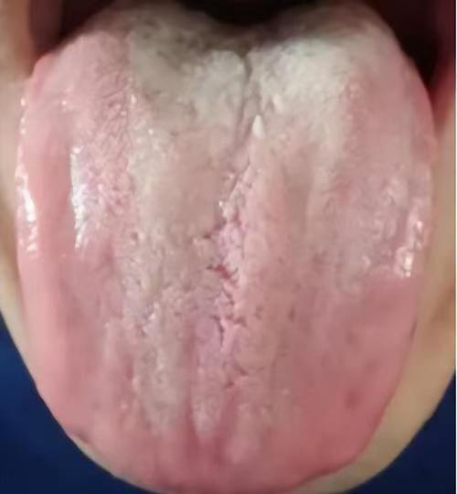 【舌诊分析】出现这种舌象，别把补阳放在第一步，小心越补越虚！

患者主诉：宗筋起