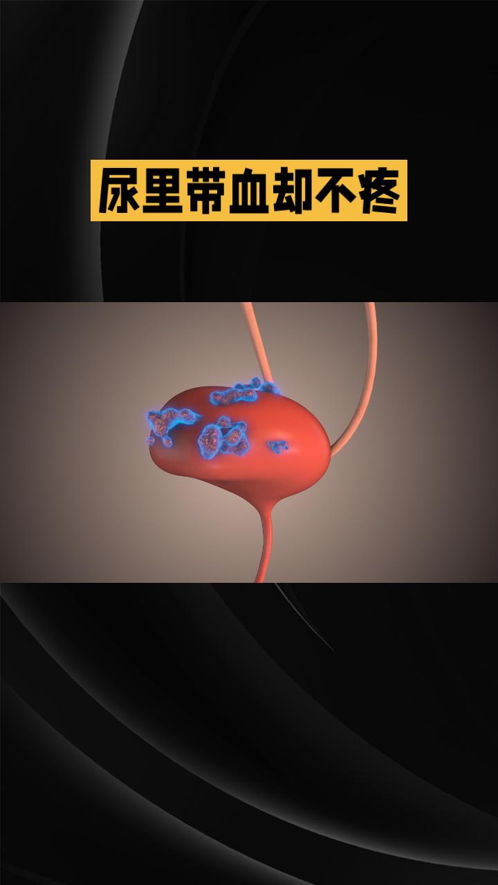 血尿你怕吗？生活中遇到血尿会很紧张，但如果无痛性血尿，反而容易掉以轻心，殊不知这