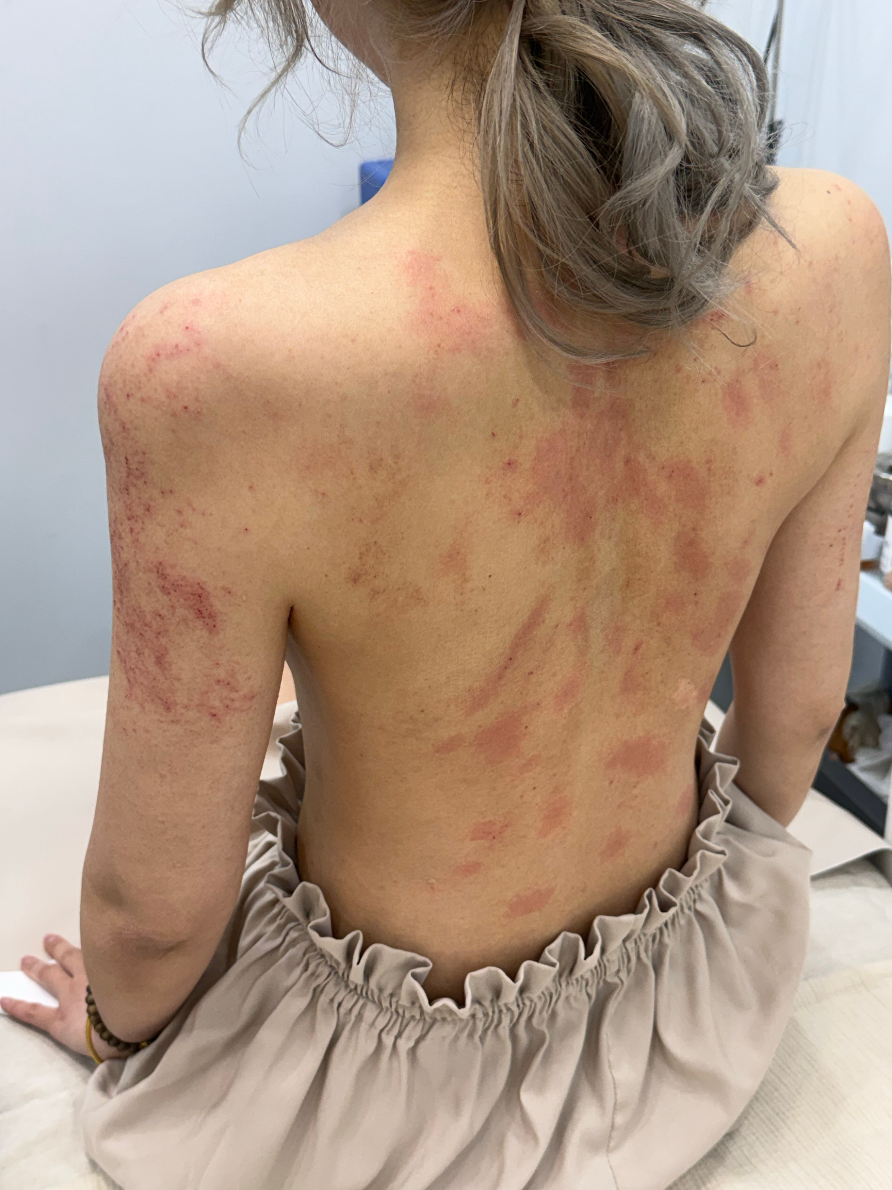 今天打完全身美白之后的皮肤。。。院长说如果有鸡皮肤的话，改善会特别大，类似于做了