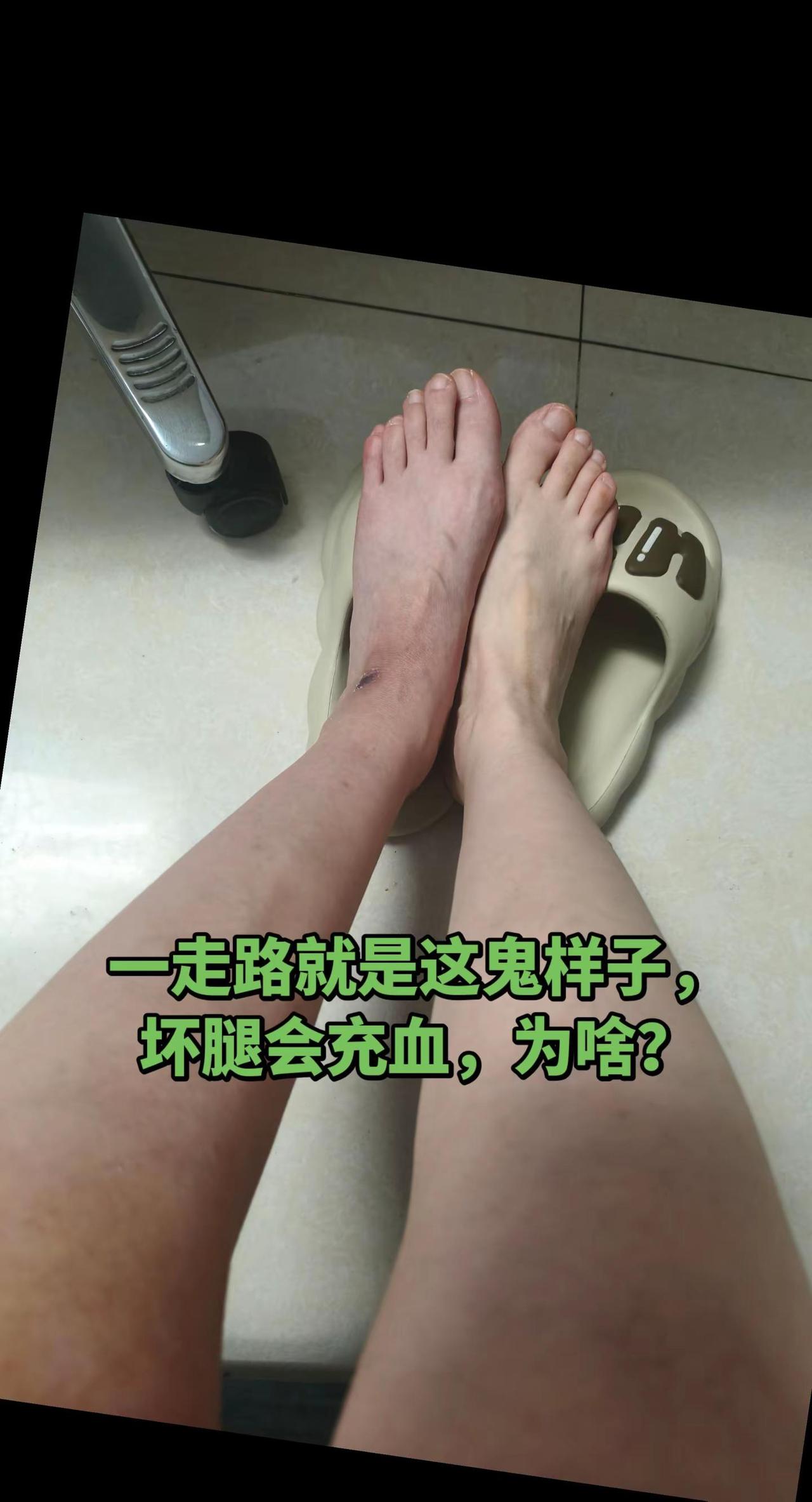 我都没想过我居然支撑不住我这90来斤的体重，不到十分钟，就累的不行，关键是充血肿