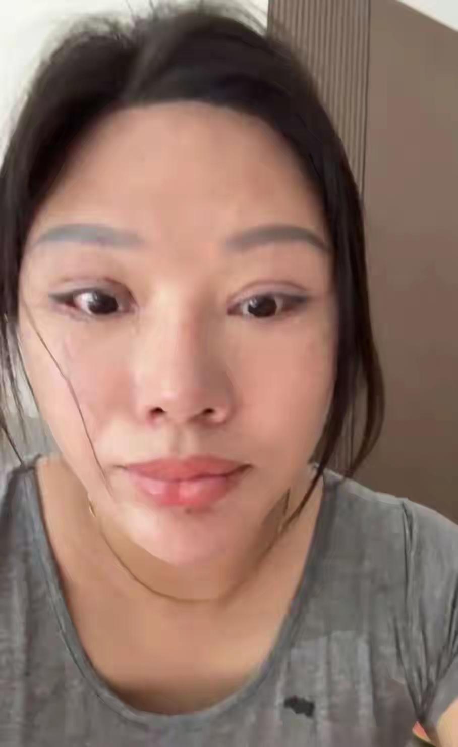 双眼皮手术致九级伤残，受害者发声被判违约退款20万

苏州女子王丽（化名）因在好