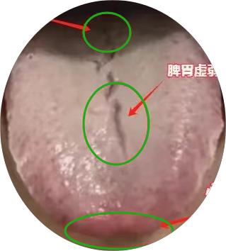这个代表性舌象，只是看着唬人，其实问题不大，用对方法还是很好调理的。
这个患者啊