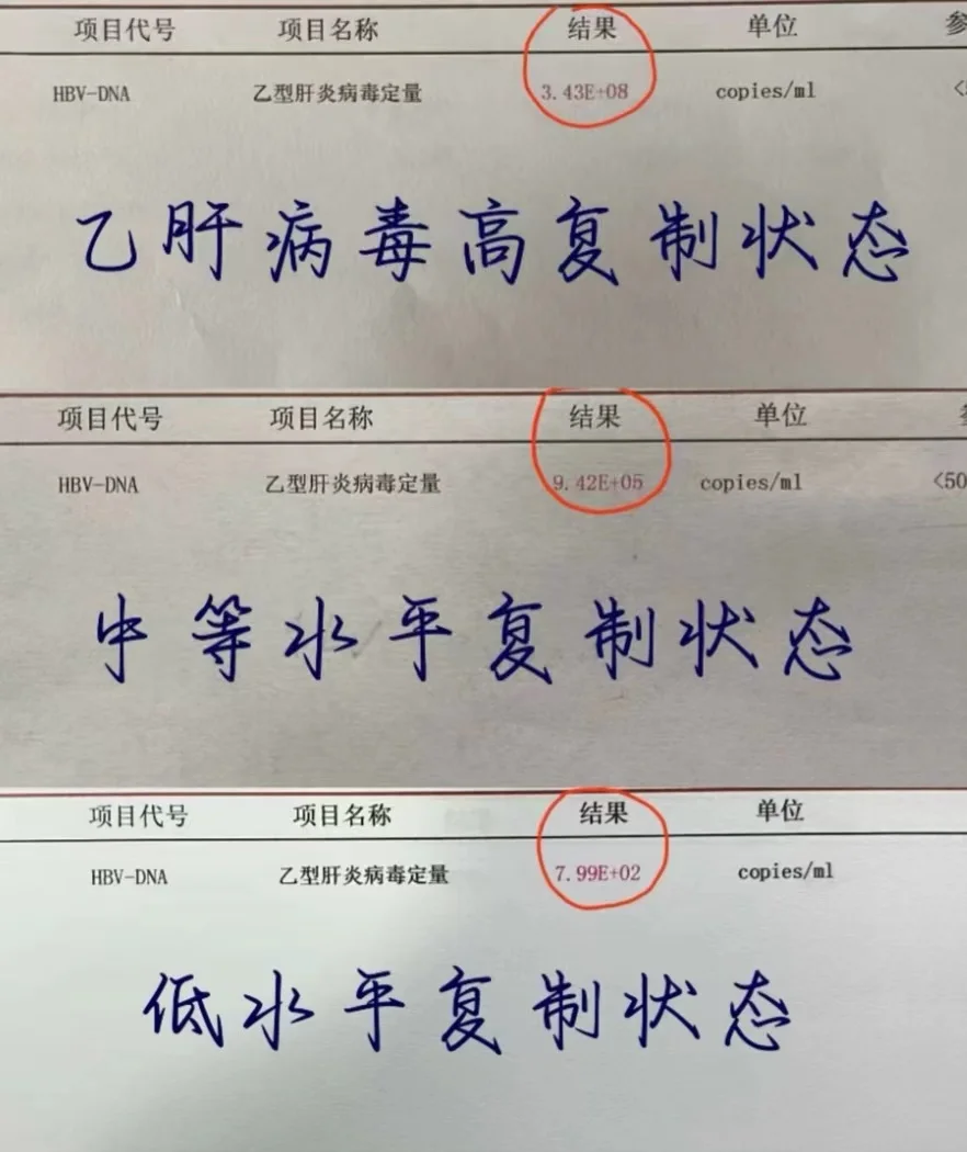 乙肝病毒复制水平怎么看？高水平、中等水平，低水平复制，看看你的病毒量处...