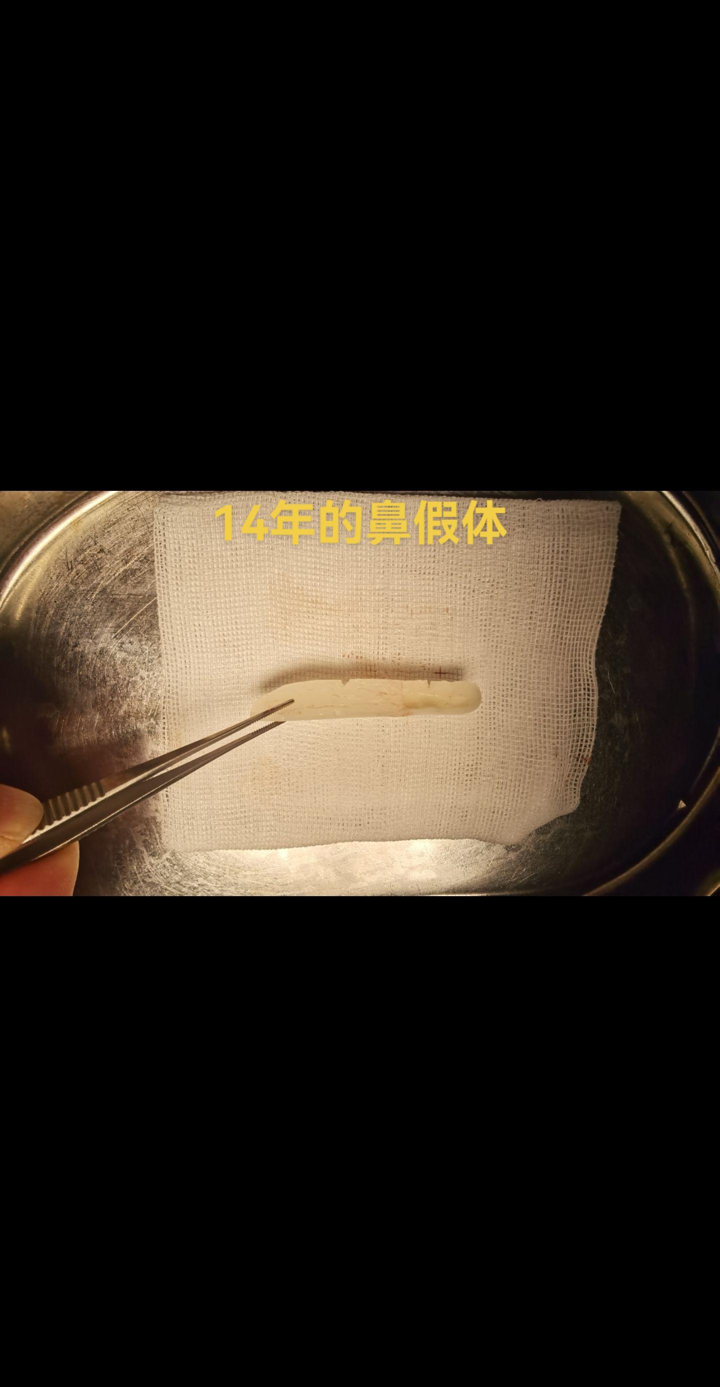 硅胶鼻假体。硅胶假体隆鼻术后14年，今天取出。