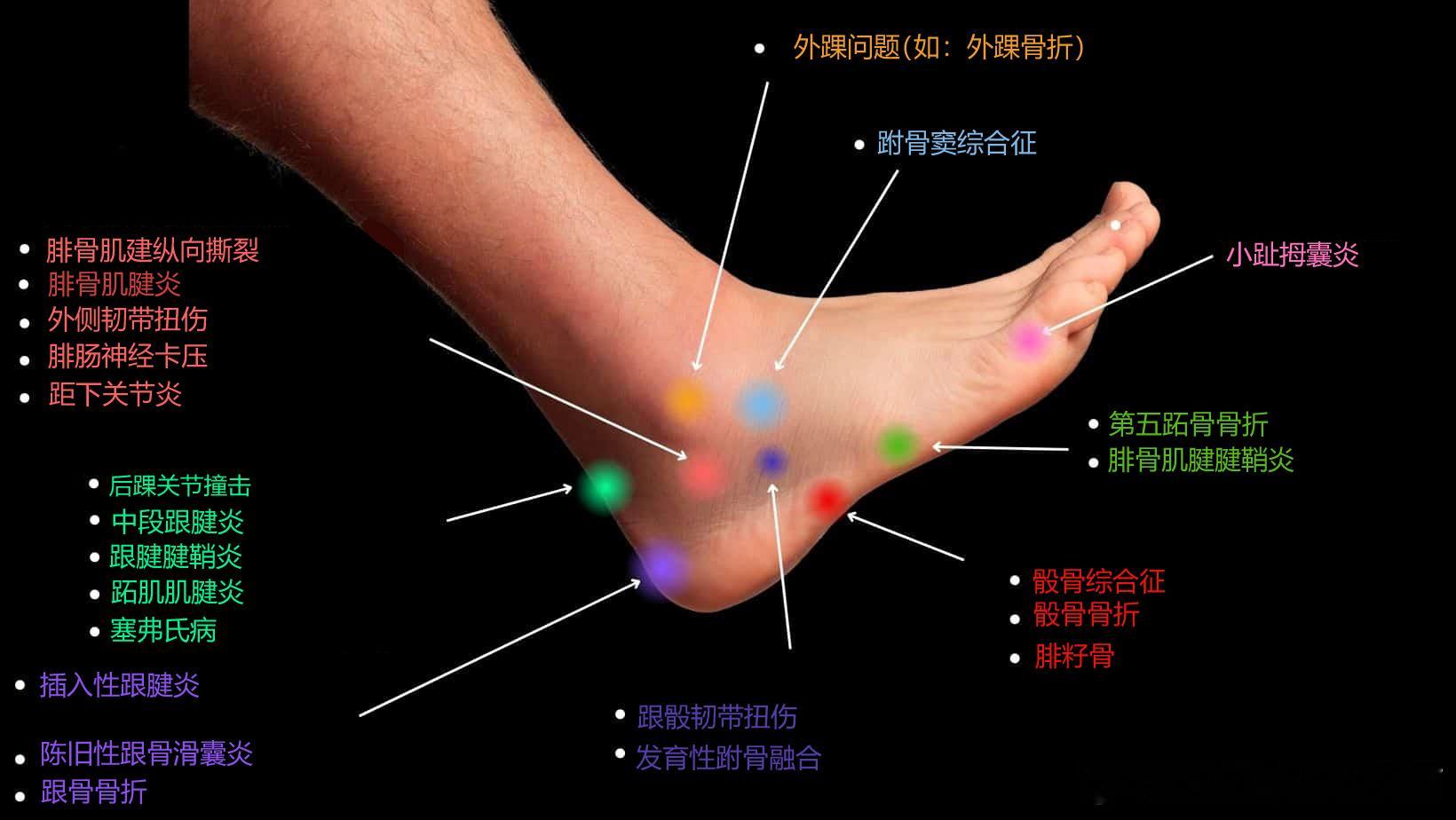 足踝疼痛盘点 脚踝真的是非常复杂的结构了，有没有踝外侧疼痛不适的朋友？目前具体是