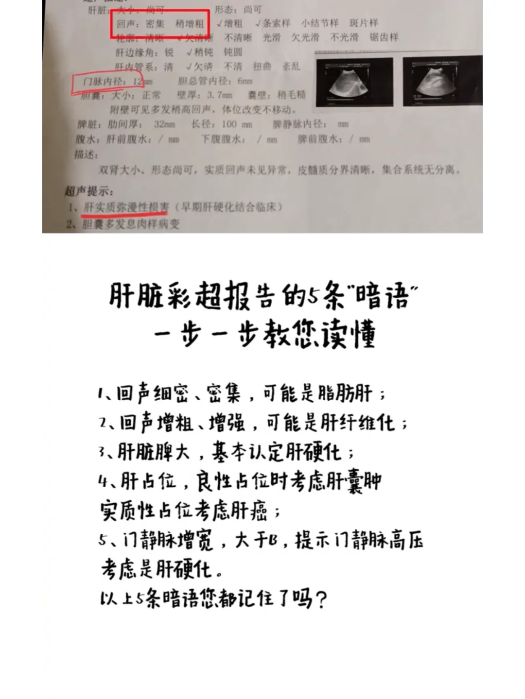 肝脏彩超报告5条暗语，一步一步教您读懂 