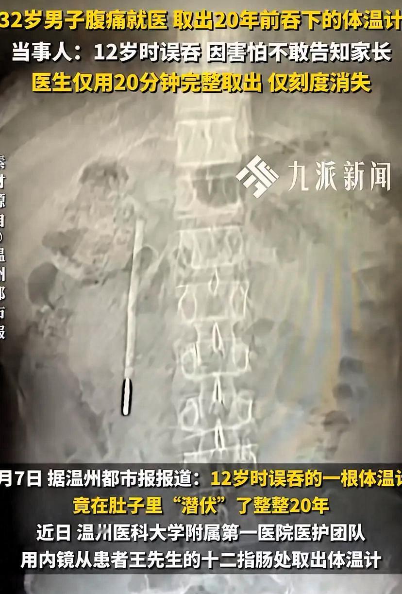 32岁的王先生最近肚子总不舒服，去温医大附一院龙港院区做了个腹部CT。
结果让医