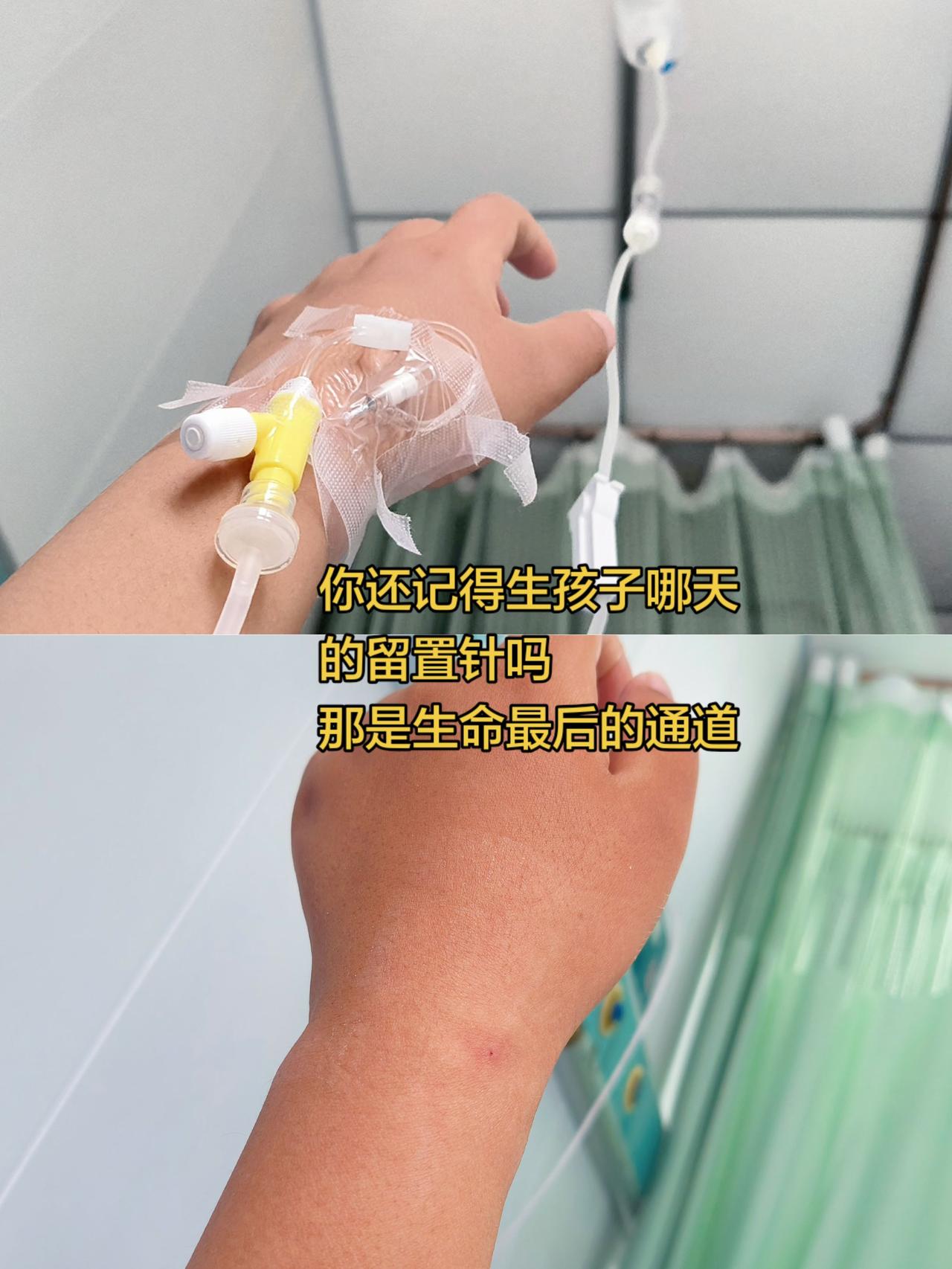 原来生孩子那天的留置针是为了提前建立静脉通道，留置针比较粗，而且挪动不会鼓包，一