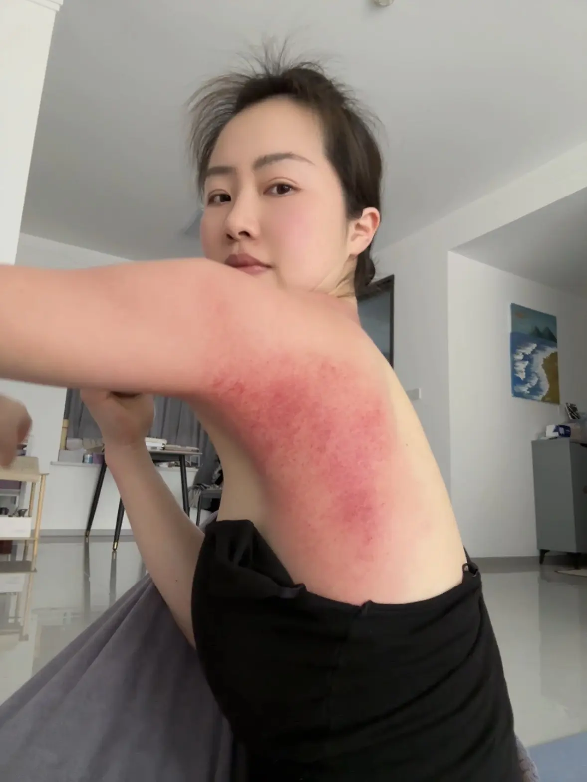 腋下后侧一坨肉肉就是堵 刮开了就薄了。