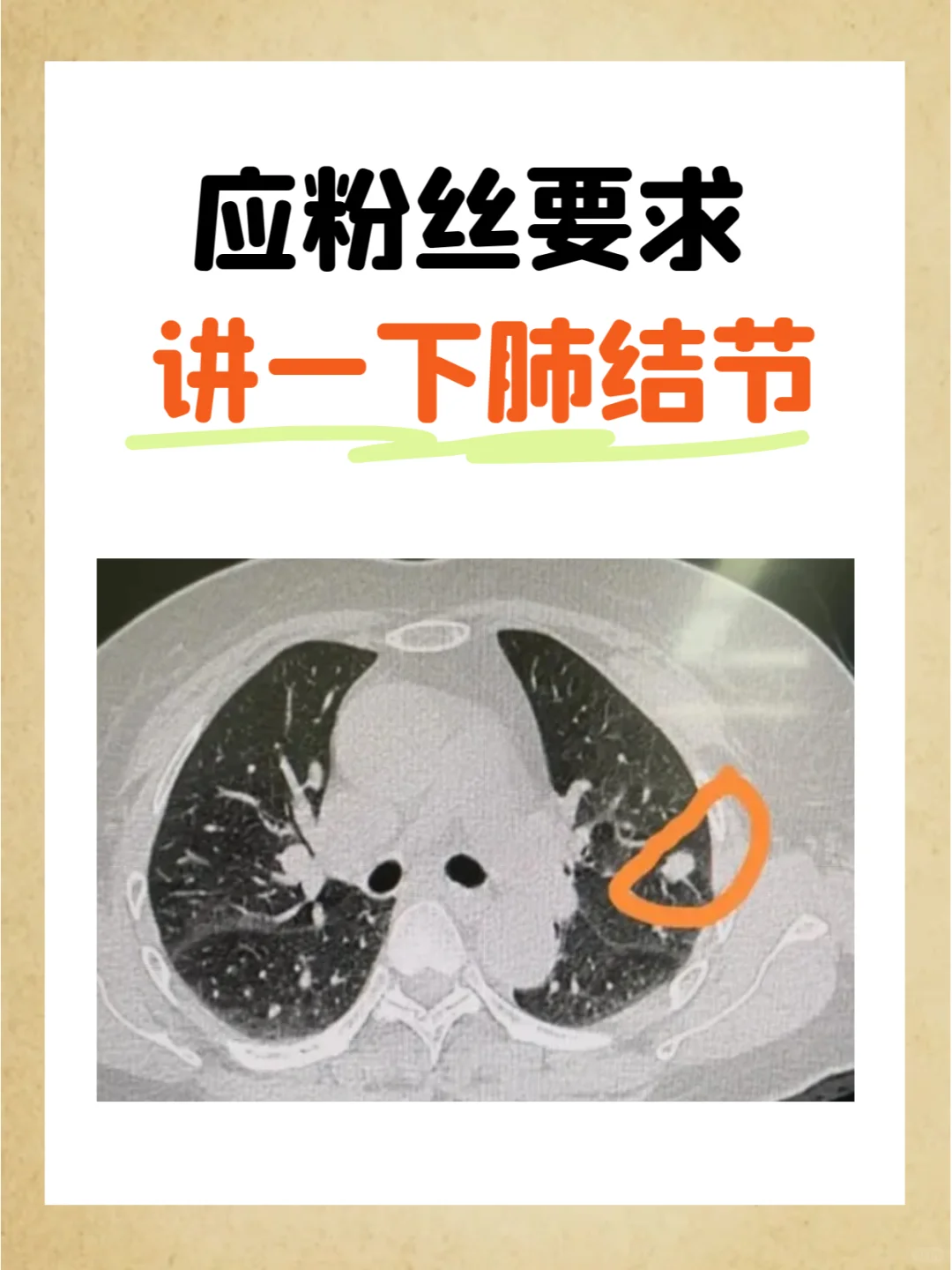 应粉丝要求，讲一下肺结节