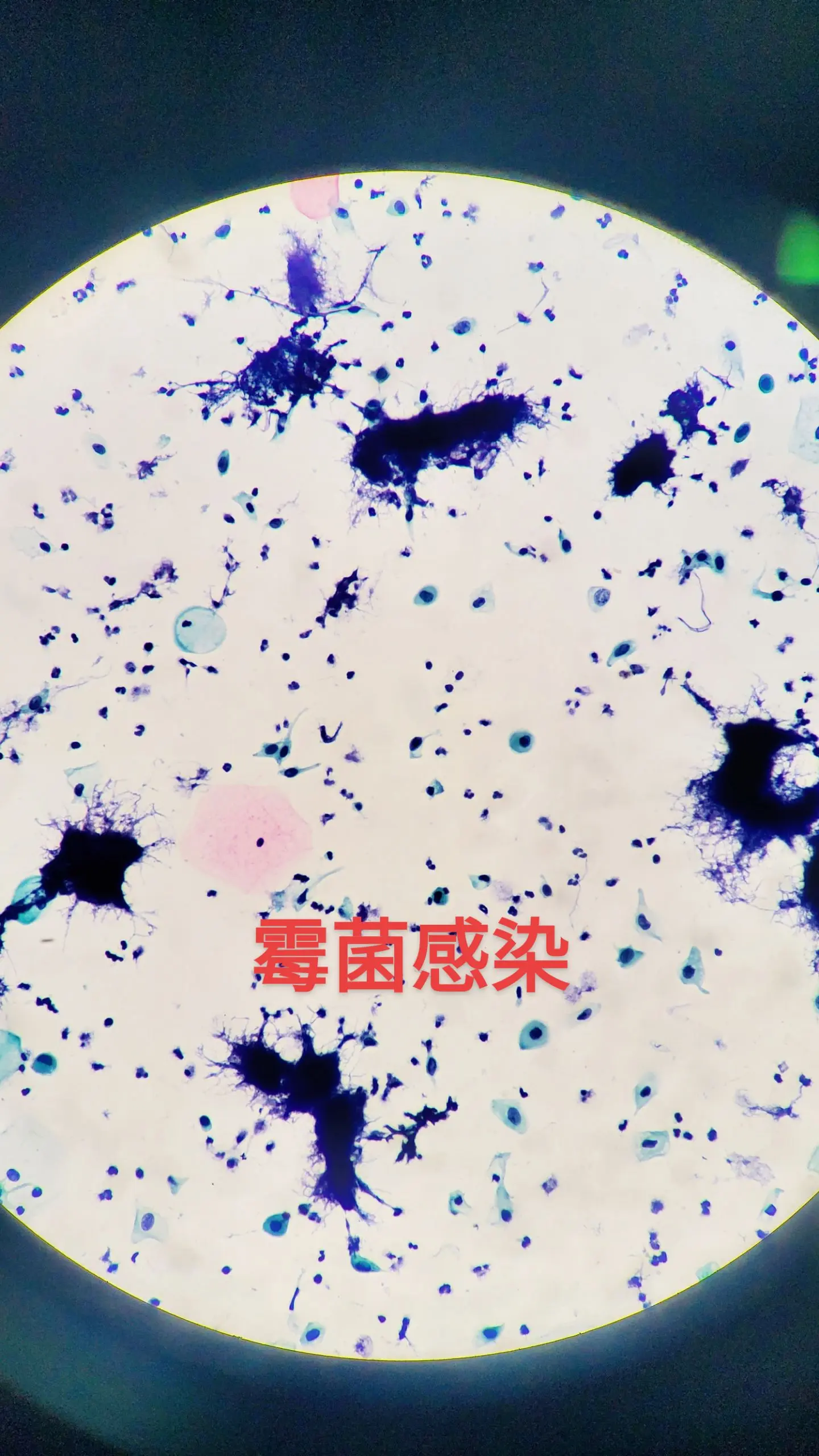 显微镜下的世界  宫颈细胞学  霉菌感染
