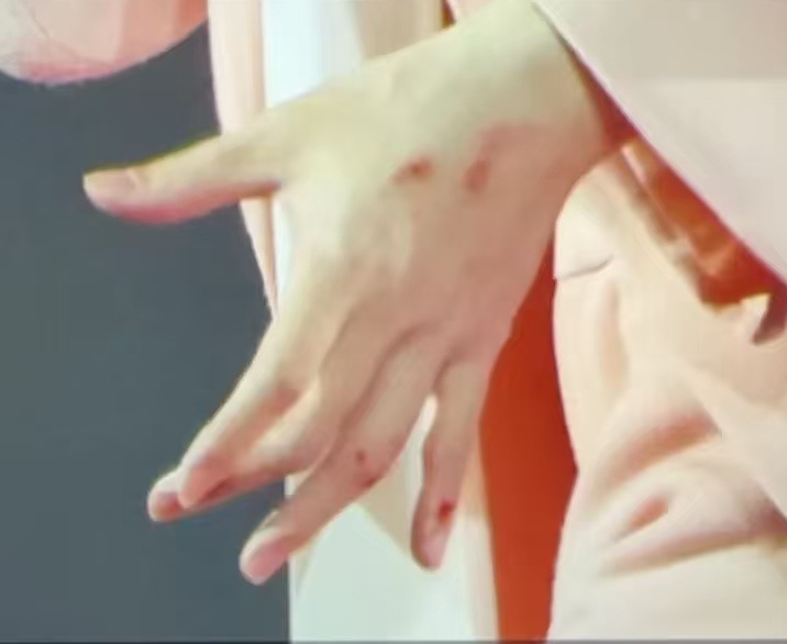 阿信摔下舞台小红薯刷到，真的好危险舞台太暗了，手背都流血了