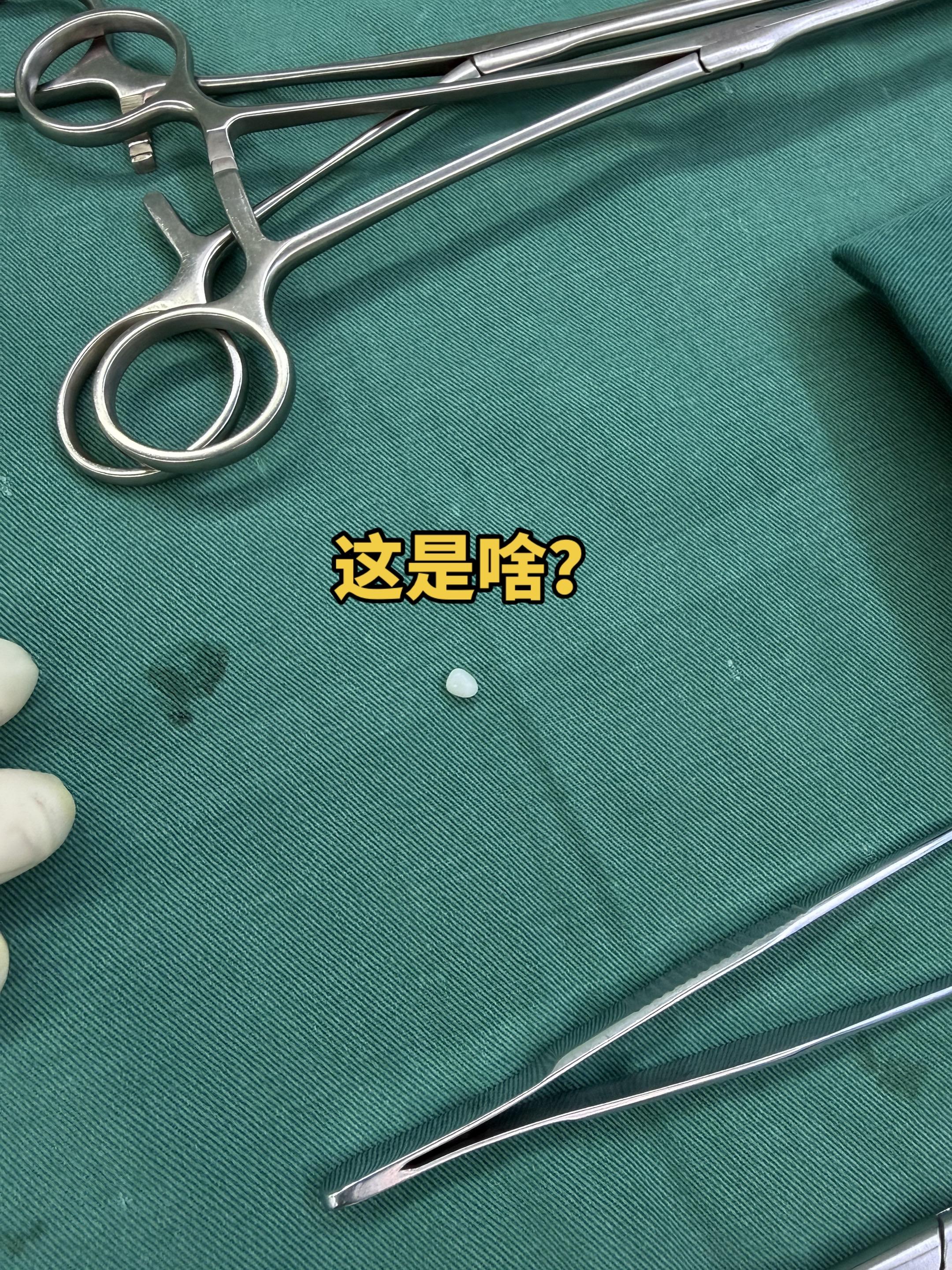 奇奇怪怪的胸腔内东西。其实是个胸壁慢性炎症形成的结石。