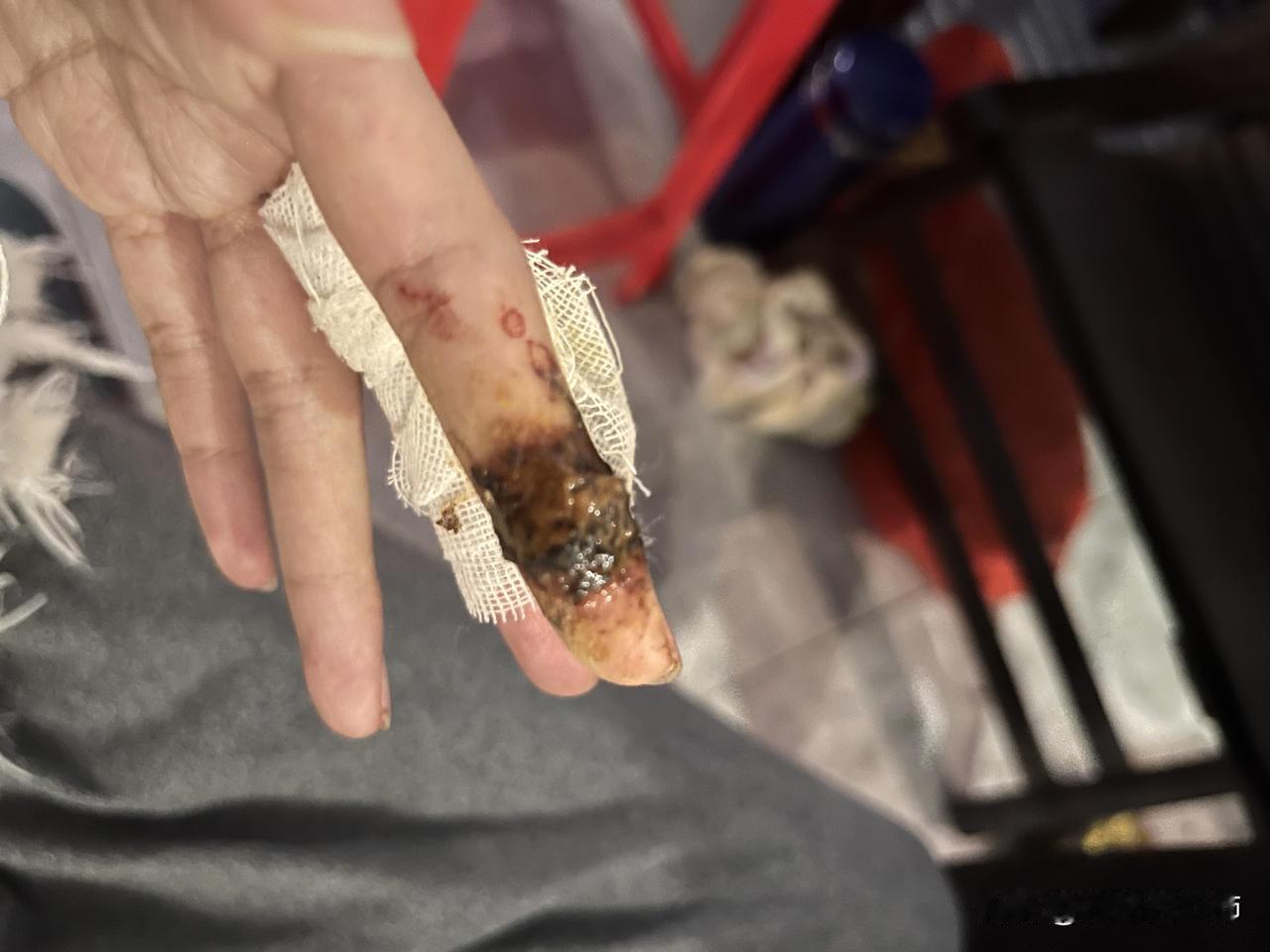 云南白药直接和伤口融为一体咋办
中午手指被割出很深的伤口，尝试多种方式止血都无效