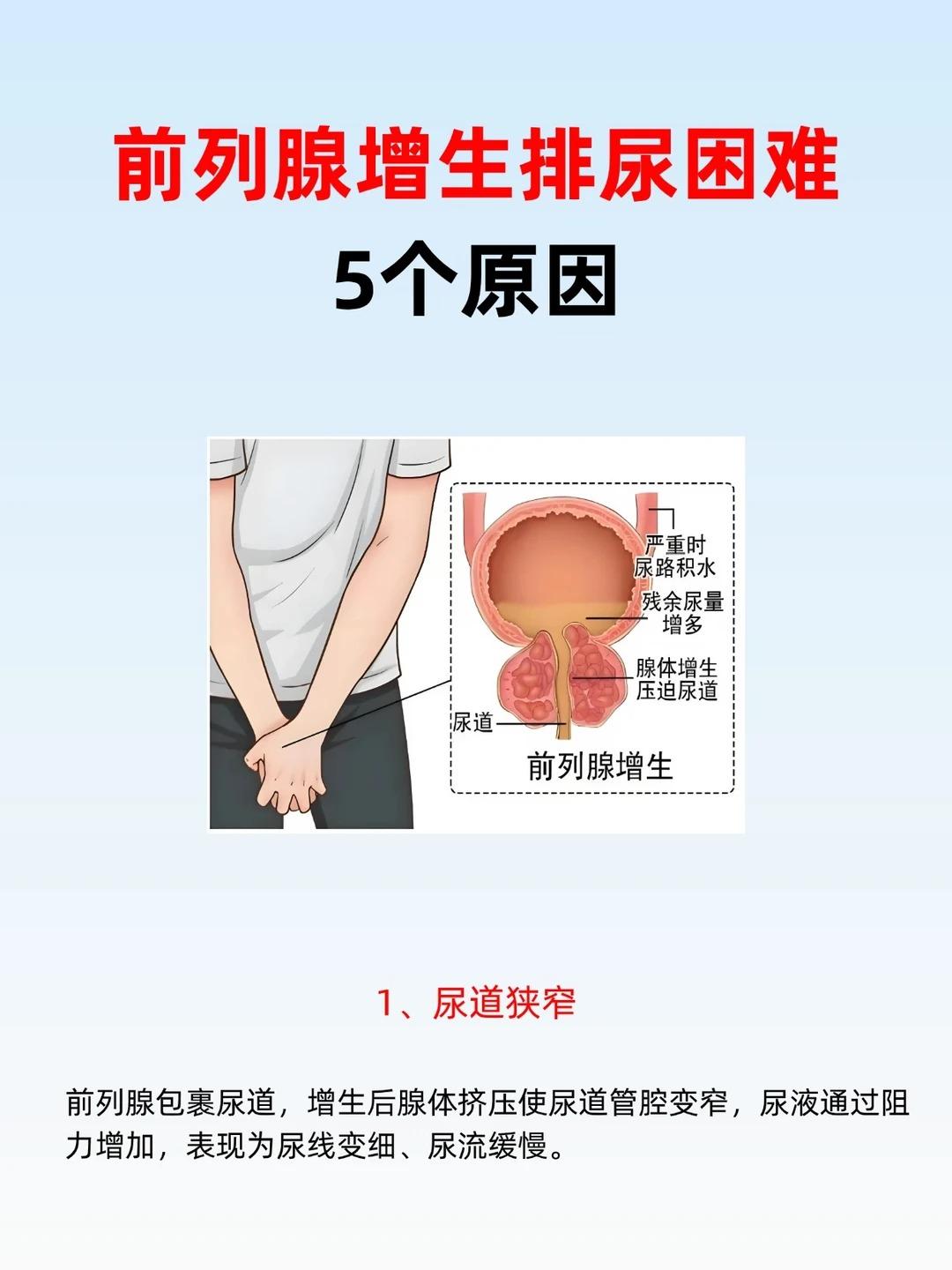 排尿费力、尿不尽：前列腺增生的 5 大诱因