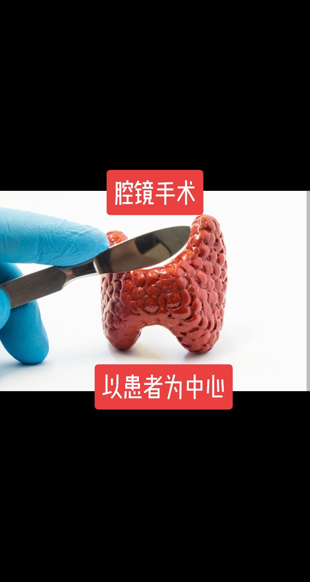 腔镜甲状腺手术，患者利益最大化。🦋🦋🦋🦋🦋🦋
为什么说腔镜甲状腺手术，是为了患者利益最大化？
腔镜甲状腺手术，随着外科腔镜技术发展，以及年轻爱美患者对颈部无疤痕的追求应运而生。
近20年发展迅速，得到了广大甲状腺患者的认可！💪💪💪
1、腔镜甲状腺手术安全有效，等同于传统开放手术。
2、颈部永远无疤痕，美观是开放手术去法比拟的。
3、费用跟开放手术相差无几，恢复也很快。手术准备较复杂，时间较长，医生更辛苦。
腔镜甲状腺手术虽好，但不是所有患者都适合，外科专家还需要不断努力，更好地服务患者！