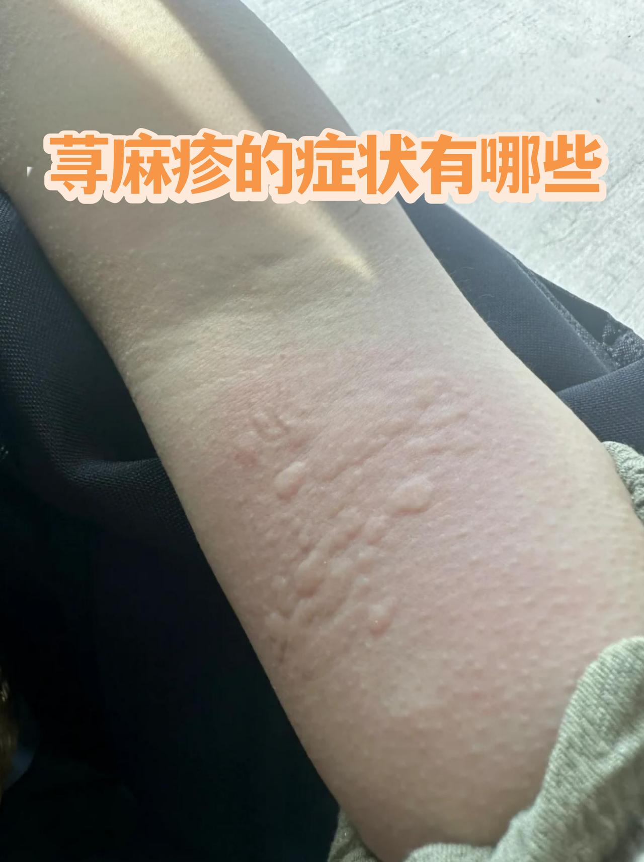 [太阳]身上莫名冒出奇痒红疙瘩、越抓越肿？认清荨麻疹分型，避开错误处理方式，出现