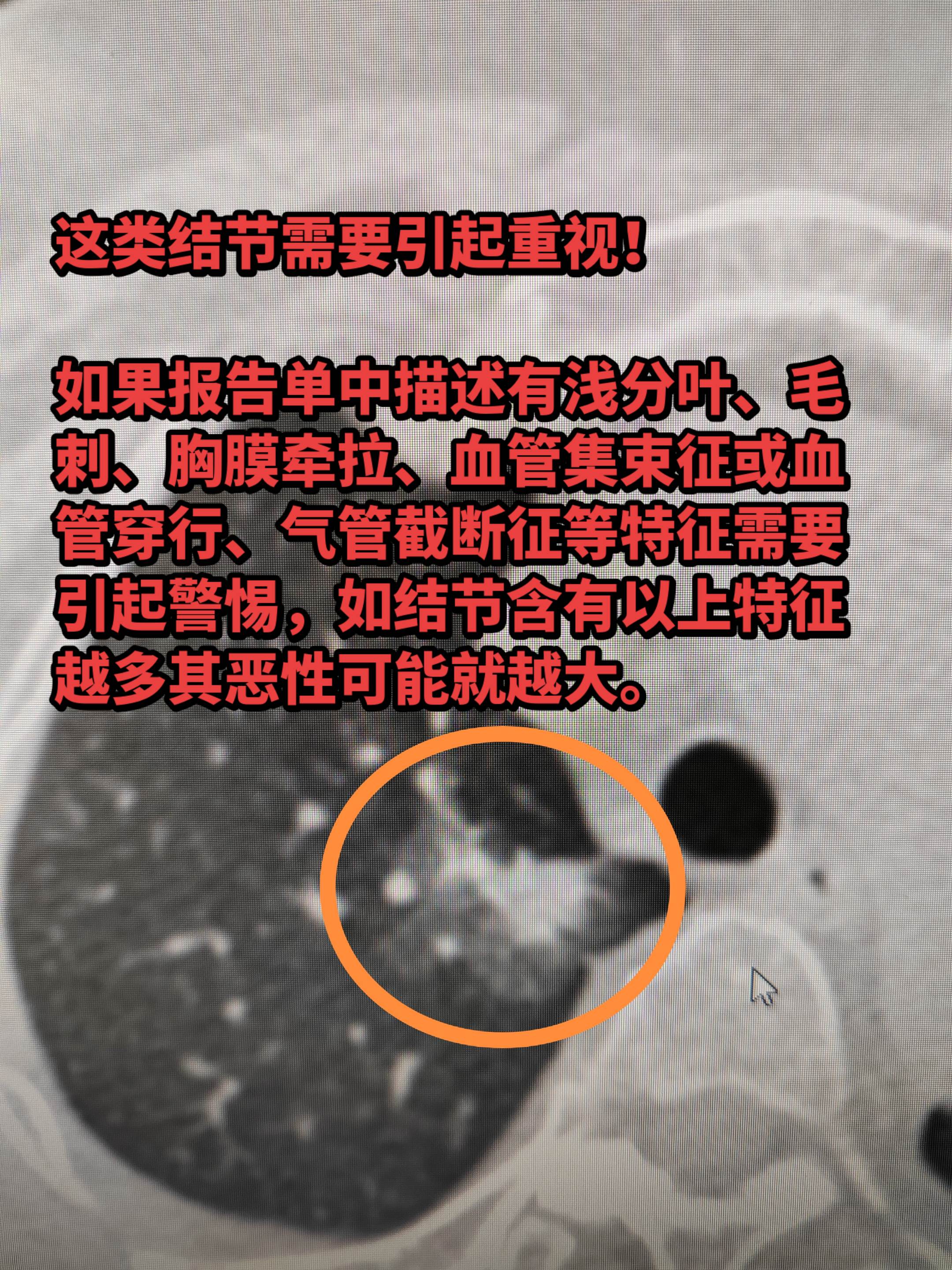 有这些特征的结节需要引起重视！如果报名单中描述有浅分叶、毛刺、胸膜牵拉...