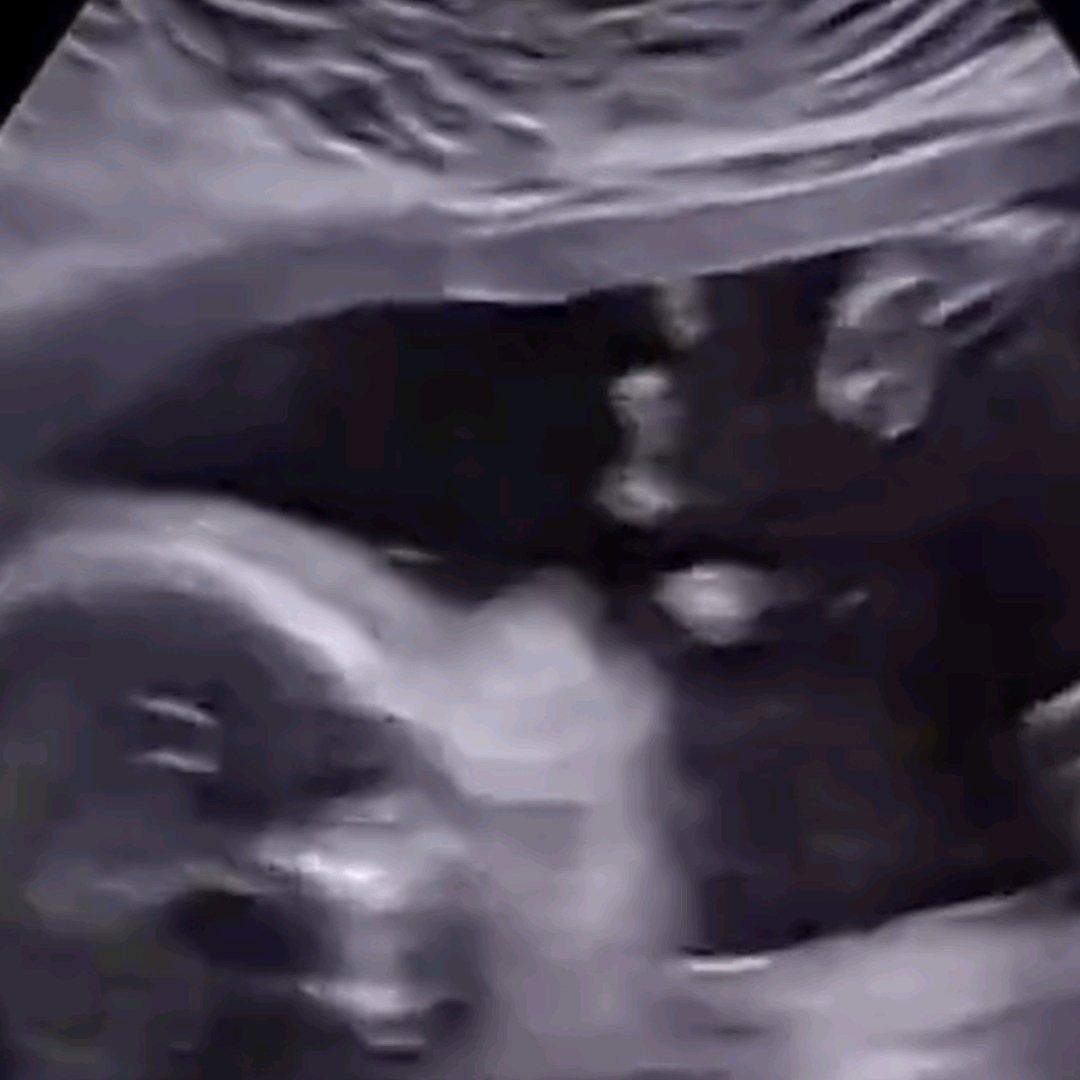 备孕8年4次流产，女子免疫系统竟把胚胎当敌人，这个指标是关键
 
谁能想到备孕路