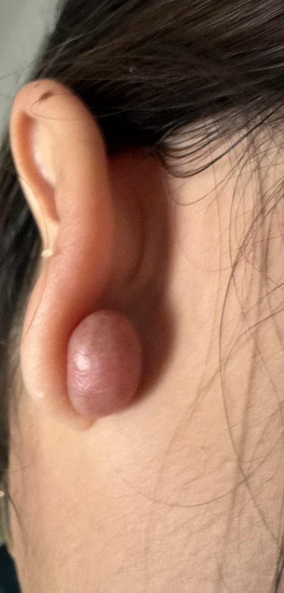 大家看看这位美女真是没病找病，这就是爱美的后果，原来是打了耳孔之后长得瘢痕疙瘩，