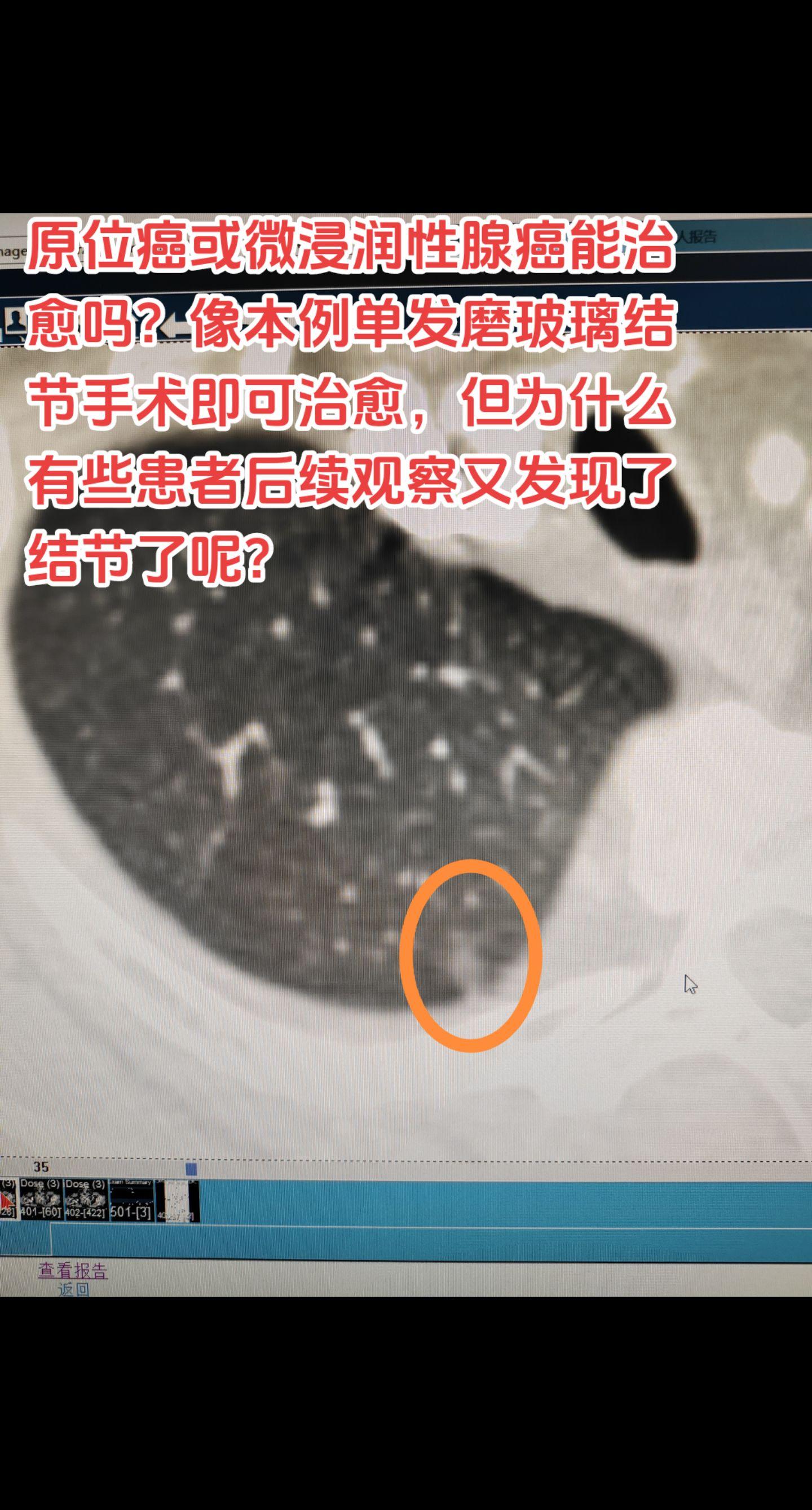 原位癌和微浸润性腺癌可治愈吗？像本例单发磨玻璃结节手术即可治愈，但为什么有些患者后续观察又发现了结节了呢？临床研究显示，肺原位癌或微浸润性癌术后有大约6%的患者会再发新的结节，但这些结节只是新发原发并不是复发转移，所以术后患者仍需定期检查。