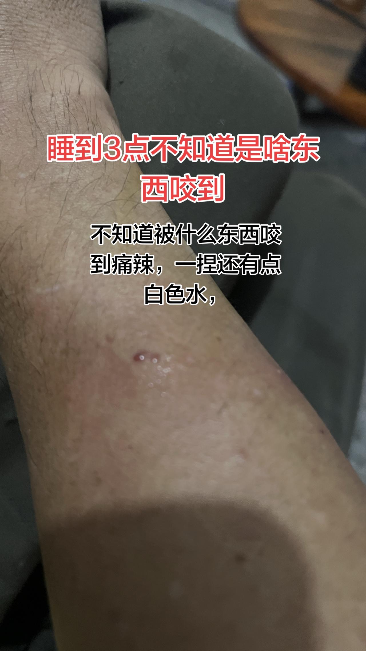 真是太奇怪了，凌晨3点，不知道被啥东西咬到，很痛，有点很辣。有点白色的水出来，两