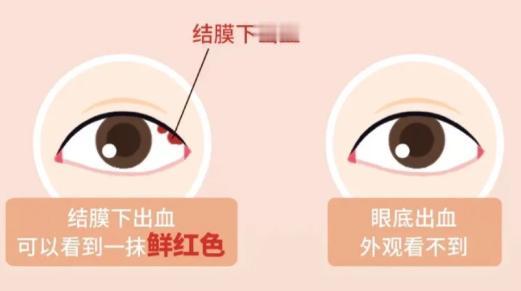 哪些人群容易出现眼底出血
眼底出血是一种较为严重的眼部疾病，常见于多类人群。高血