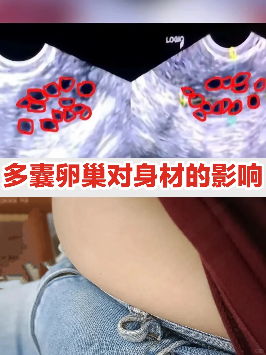 已中招！多囊对身材的影响。。。。。