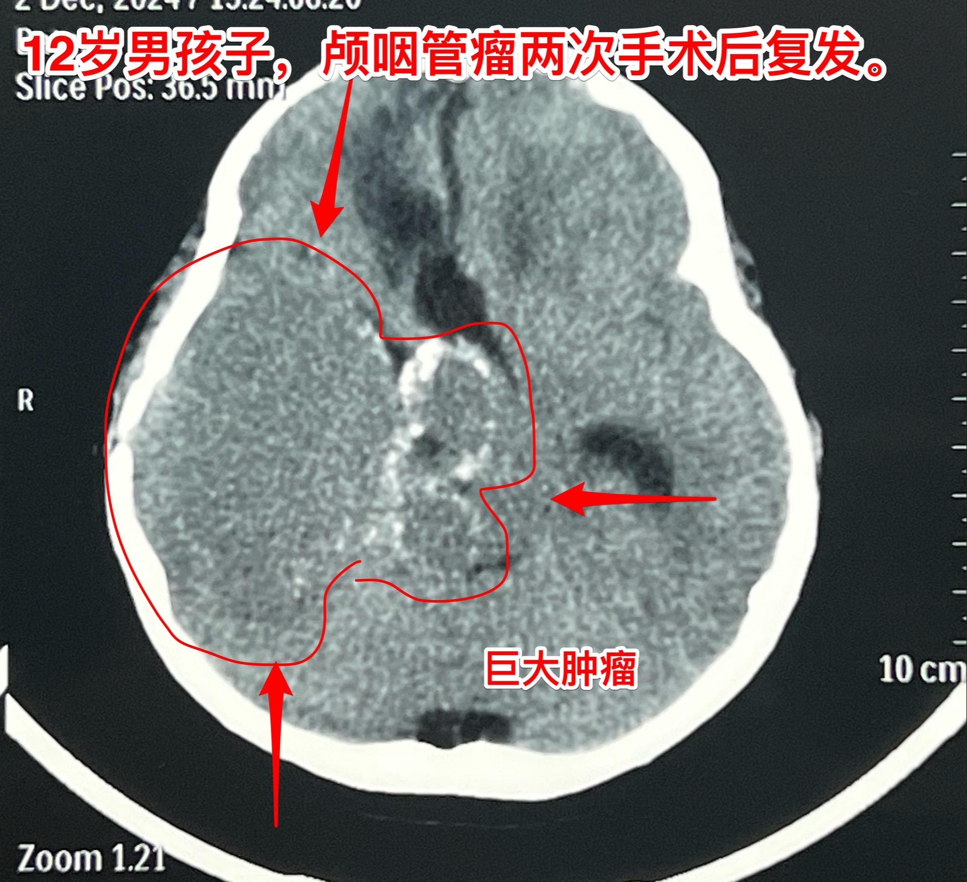 8厘米大的复发颅咽管瘤，也要争取切干净。12岁男孩子，广东省茂名市人。...