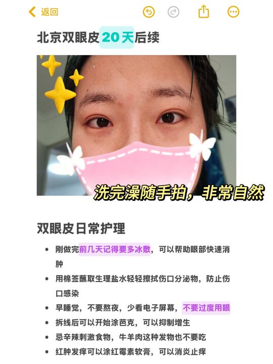 北京双眼皮20天后续