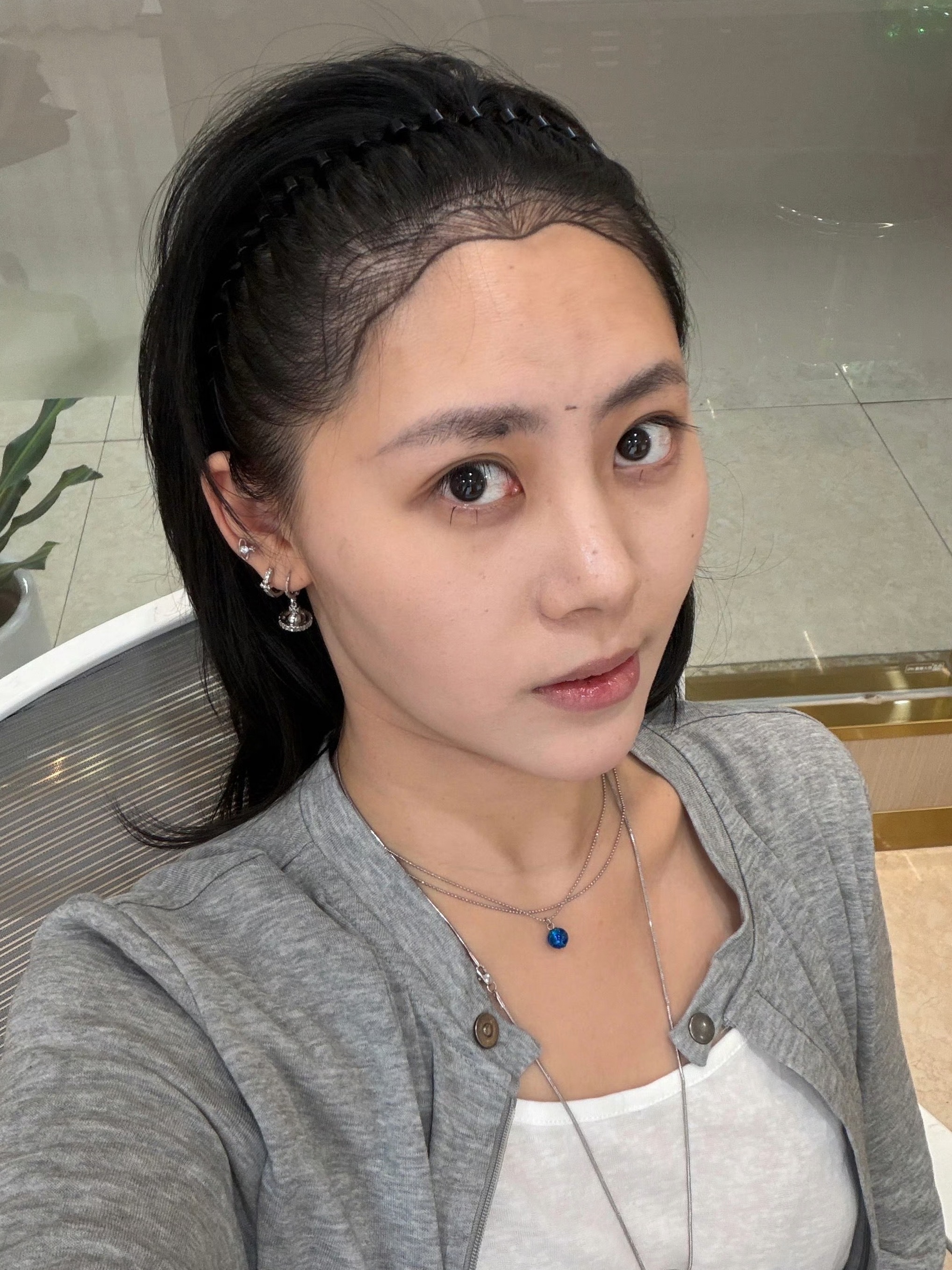 看到小晴表妹已经植发了，原因是发际线高，我在网上看到说这个植发也会掉，但是分情况