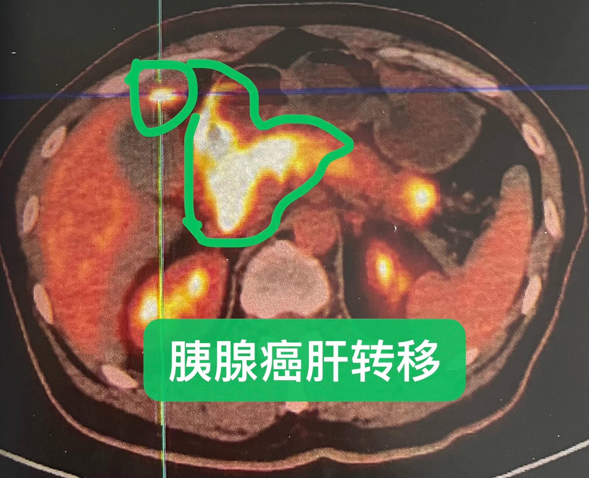 胰腺癌多发转移的协同治疗。患者完善检查后，颅骨区域组织行病理活检：转移...