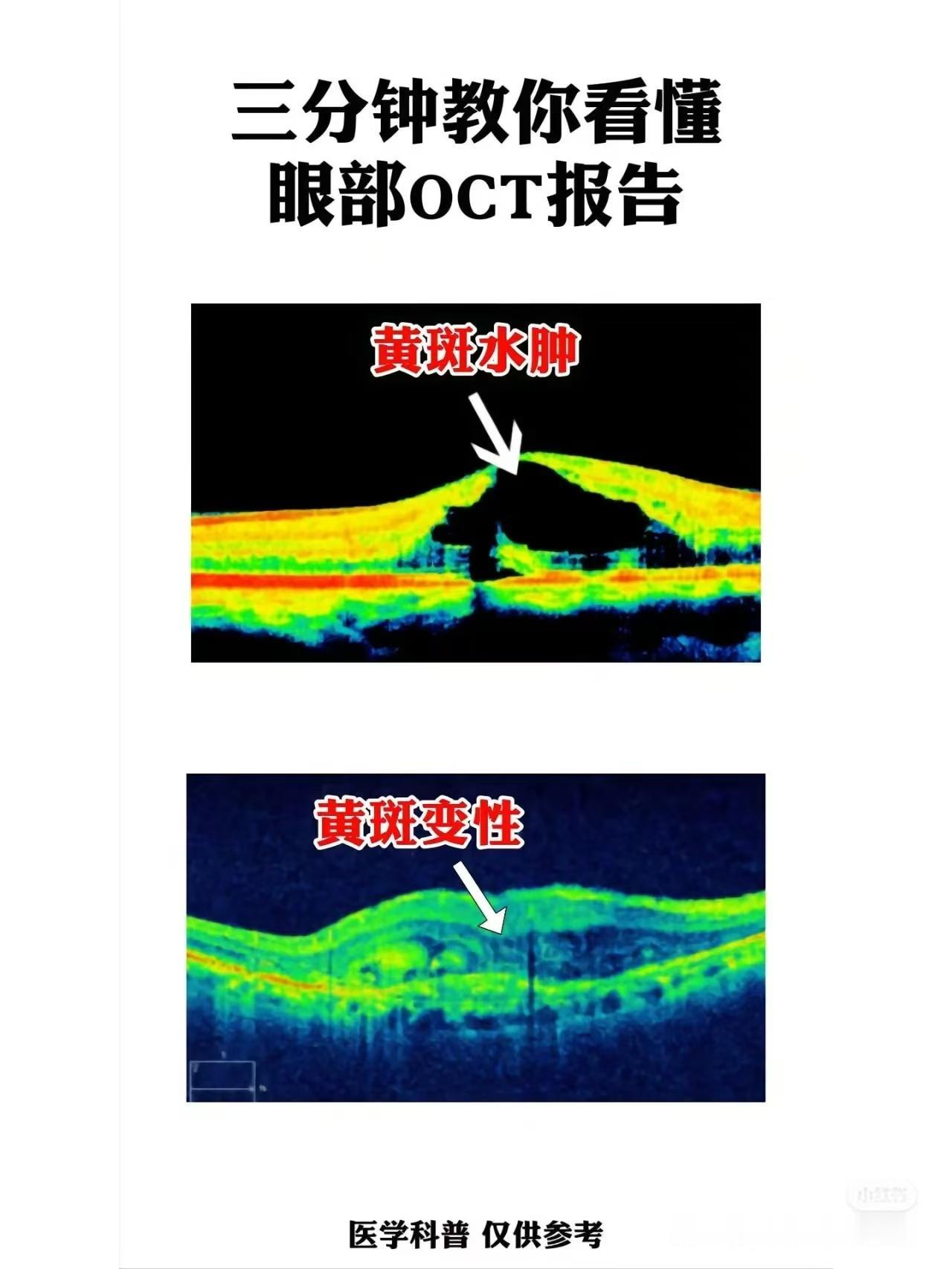 黄斑水肿要打几针才会好？反复，那就别再坚持了，试一试中医
黄斑水肿是指眼底视网膜