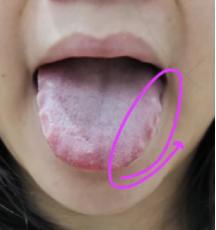 出现这种舌象，别再进补了！不疏通，补的越多，虚的更厉害！
这里说的虚，指的是脾虚