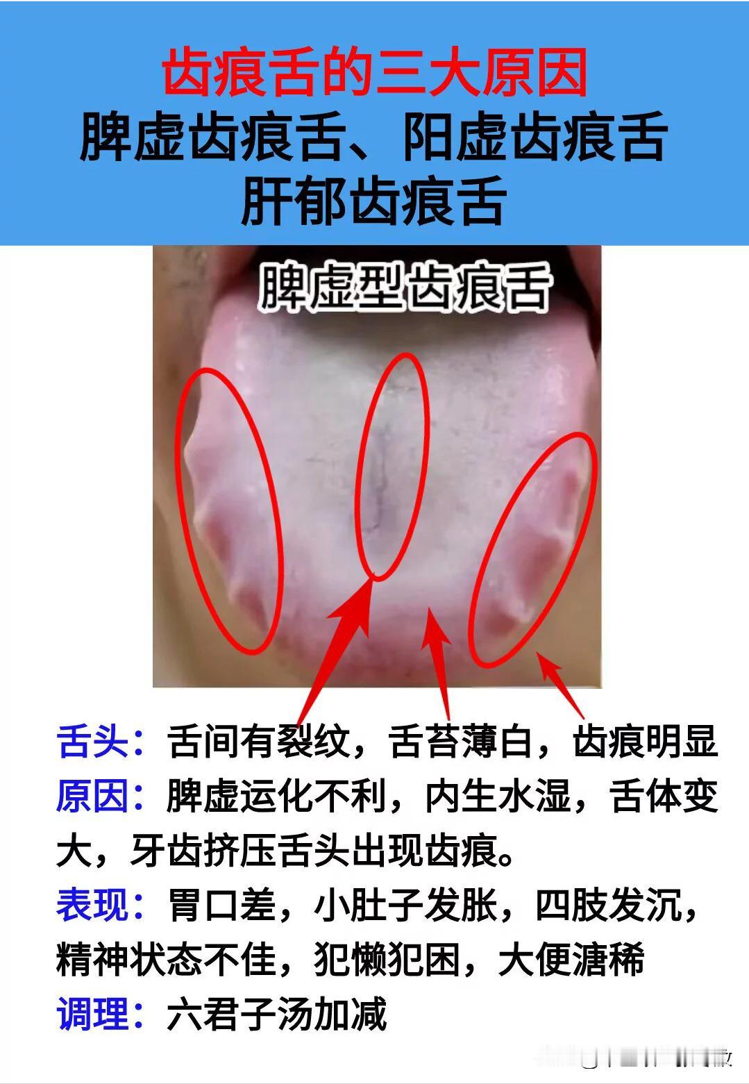 舌边齿痕就像啤酒盖，原因都在这三点
阳虚型，肝郁型，脾虚型
中医一分钟教你辩证，