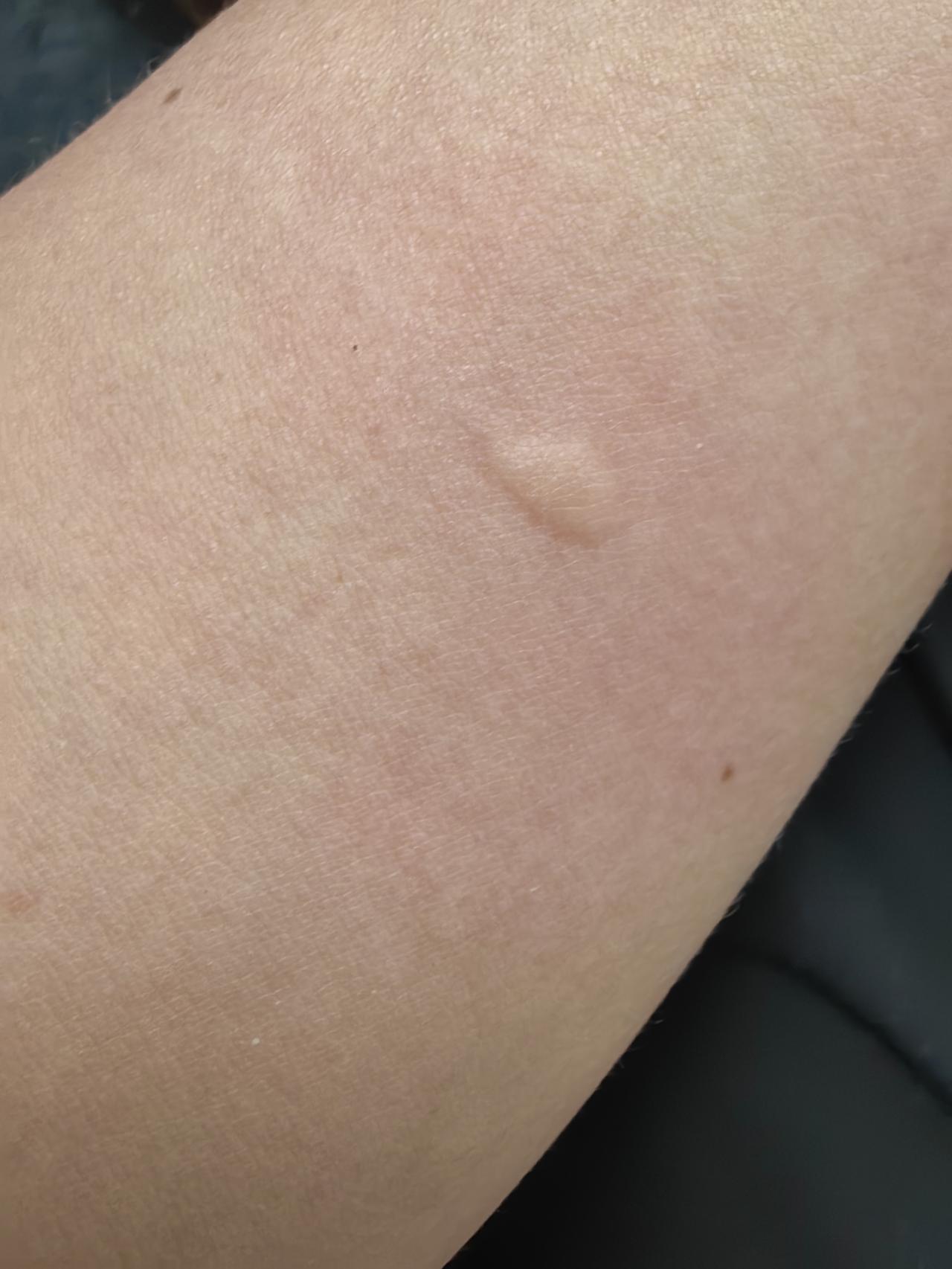 胳膊上的包就是这个图片里的，屁股上面的没法拍[捂脸][捂脸][捂脸]
今年因为蚊