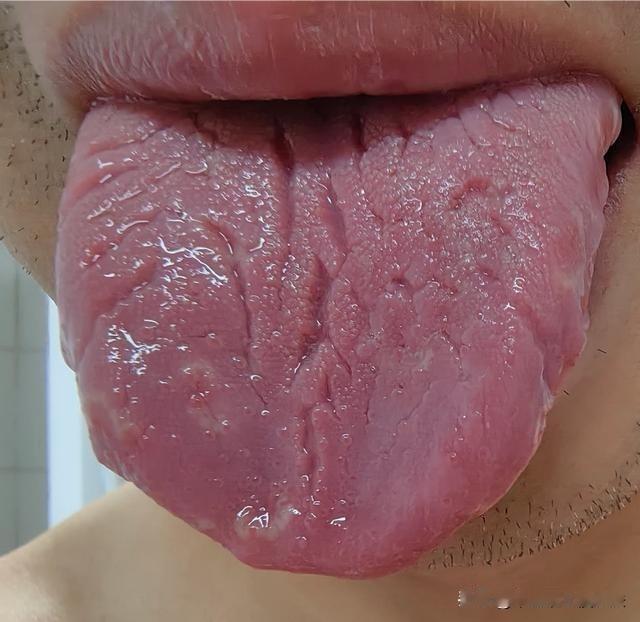 裂纹铺满舌头，可不是肾精亏虚了，你这是五脏都虚啊[狗头]！

这位小哥，才28岁