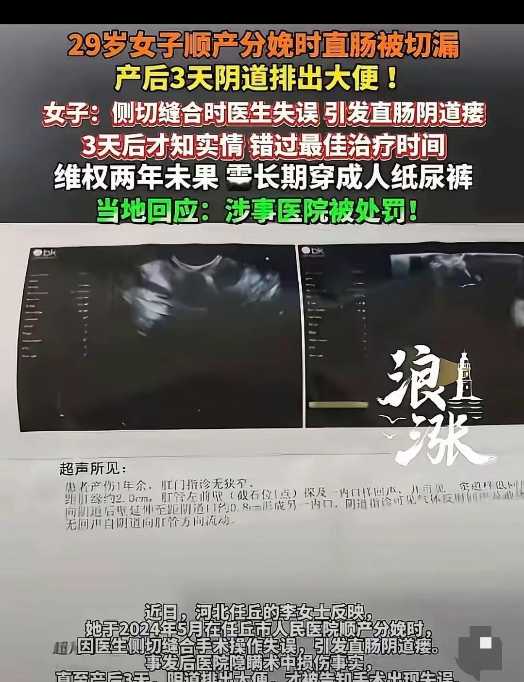 一29岁女子顺产分娩手术时直肠被切漏，但是医院却隐瞒术中损伤事实，没想到她产后3
