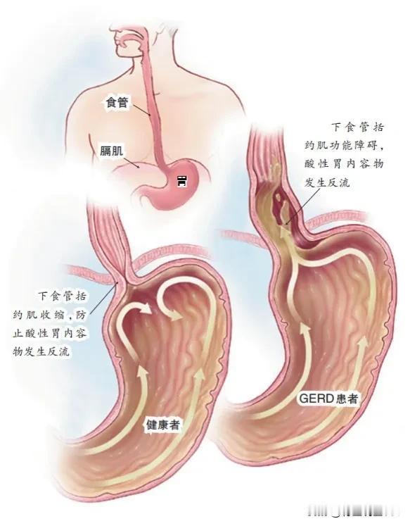 治疗反流性食管炎的药物，一文总结

随着现代生活节奏的加快，反流性食管炎已成为困