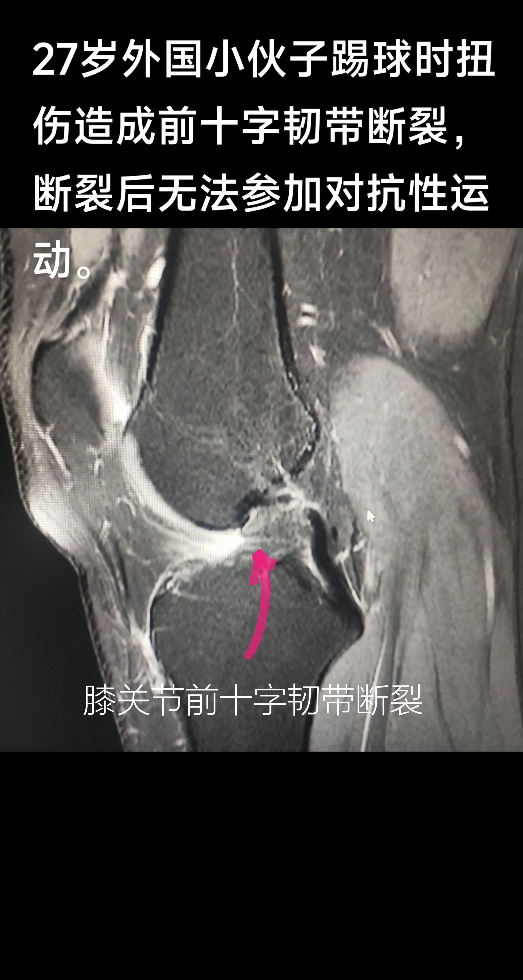 膝关节前十字韧带重建。