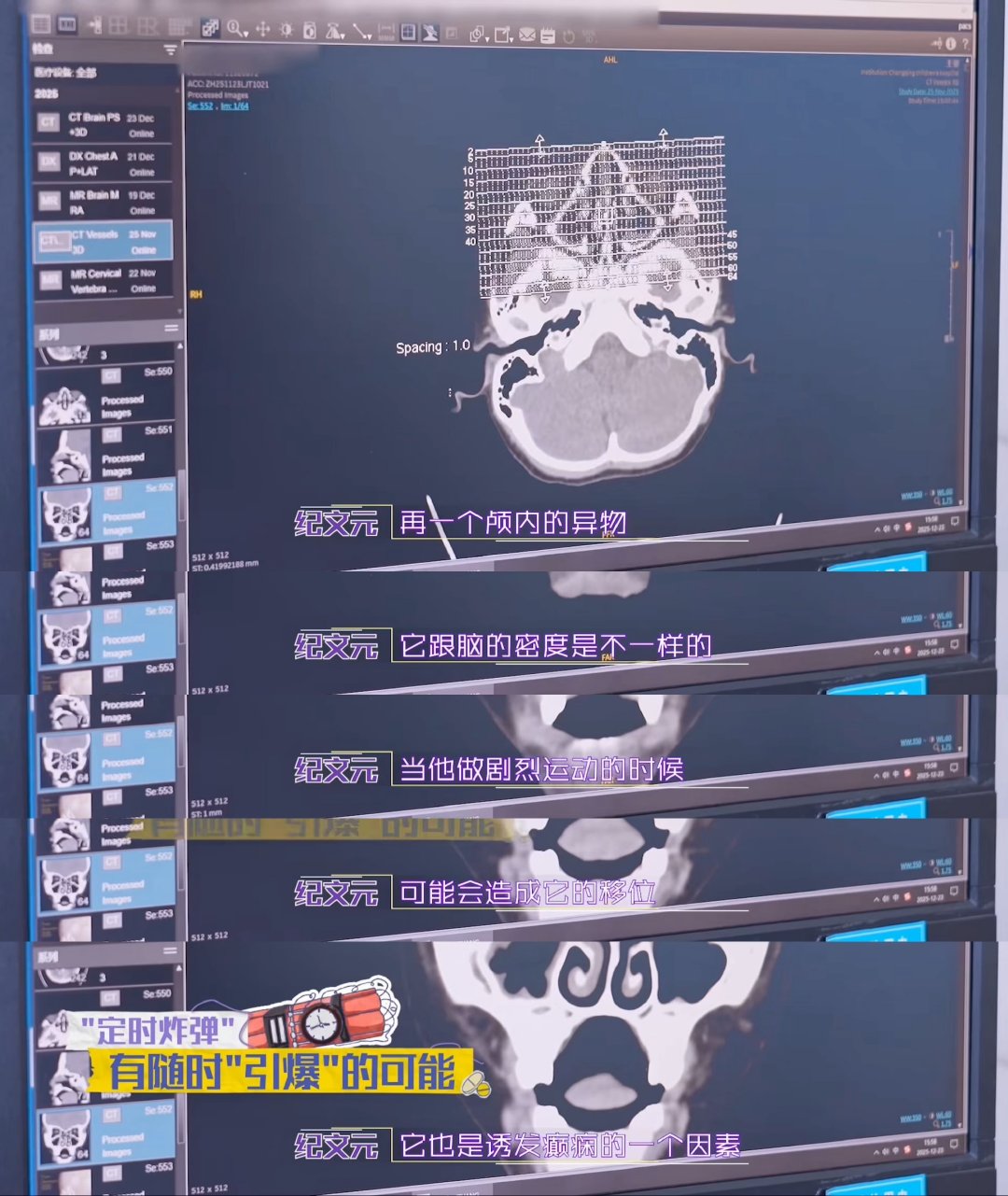 没有危险的时候孩子就是最大的危险闪闪的儿科医生6岁男童不慎将铅笔芯戳入鼻腔，异物