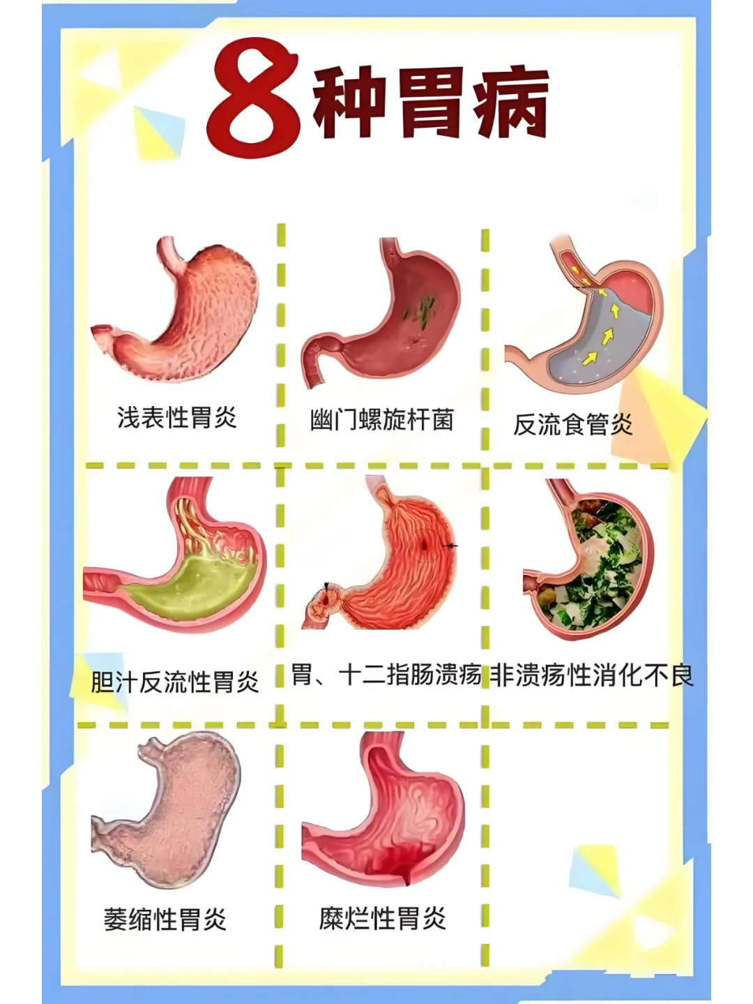 常见的8种胃病 通常会有哪些症状