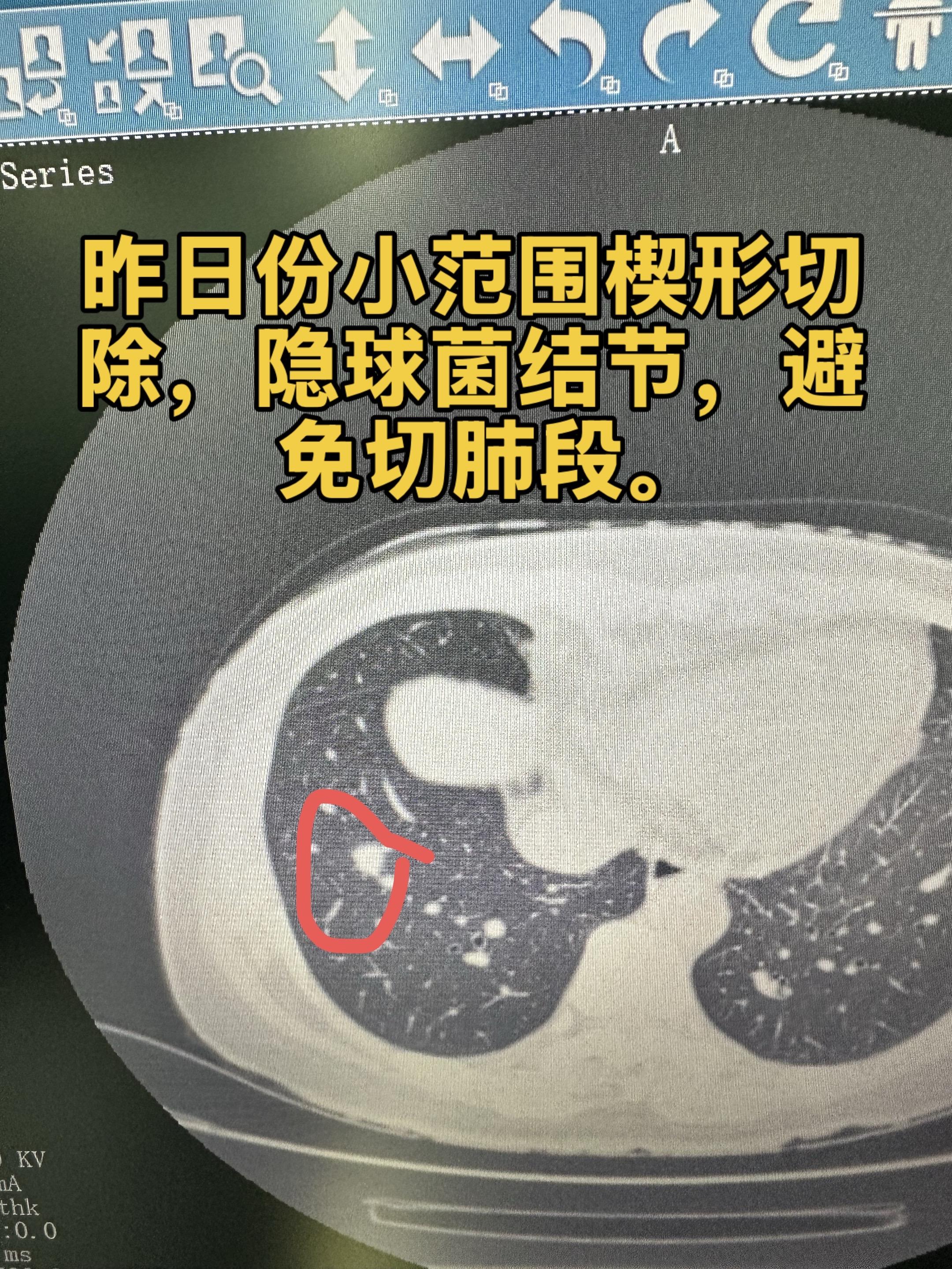 昨日份小范围楔形切除，避免段切。昨日份小范围楔形切除，隐球菌结节，避免切肺段。